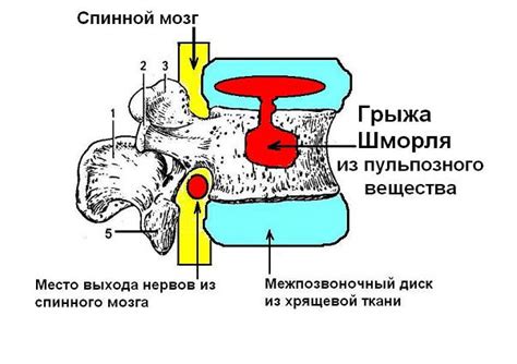 Анатомическая структура хрящевых узлов шморля