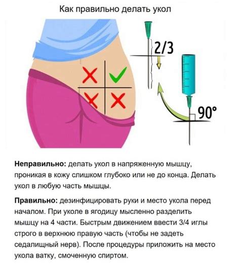 Безопасные шаги для введения препаратов в ягодицу пациента