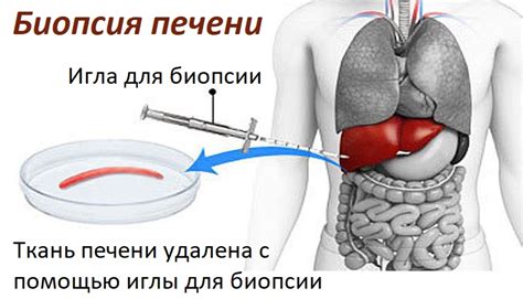 Биопсия яичников - инвазивный метод для получения точных данных о резервах яйцеклеток