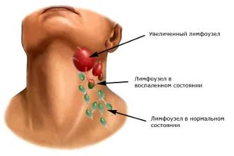 Важность регулярного мониторинга состояния лимфоузлов