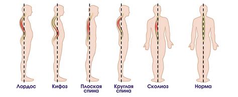 Виды инъекций при деформации пластинок в области шейного отдела позвоночника