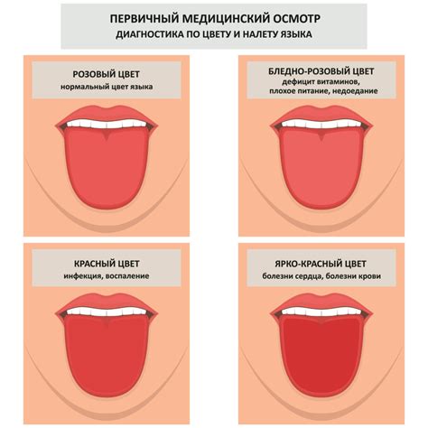 Виды отложений на поверхности языка