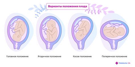 Влияние положения плода на ход родового процесса