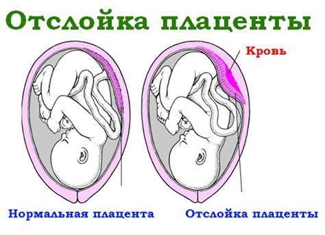 Возможные исходы после отделения плаценты у плода