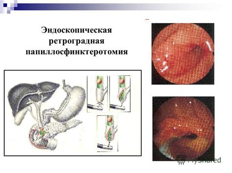 Возможные осложнения эндоскопической папиллосфинктеротомии