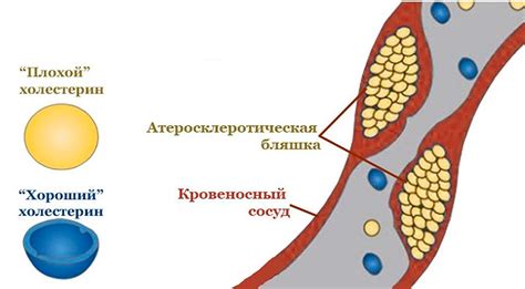 Высокие показатели ЛПНП: причины и последствия