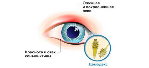 Демодекоз – причина дискомфорта на поверхности глазных век