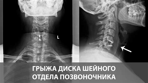 Диагностика распространенного заболевания в области шейного позвоночника