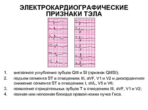 Другие электрокардиографические признаки Эос полувертикальной