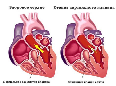 Заболевания сердца и сужение в груди: патологии, сопровождающие неприятные ощущения