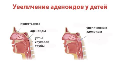 Знаки и симптомы увеличенности аденоидов у малыша