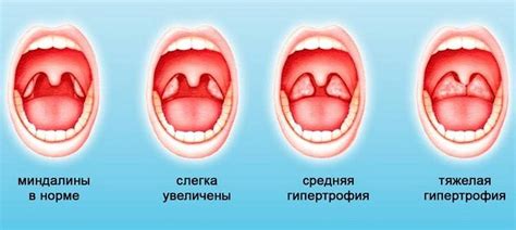 Как определить проблему с гипертрофией нёбных миндалин у ребенка