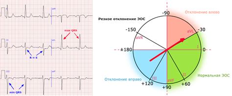 Клиническое значение Эос полувертикальной на ЭКГ и необходимое лечение