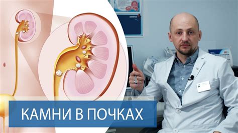 Консервативное лечение камня в почке: применение лекарственных препаратов