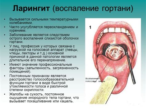 Ларингит: симптомы, причины, лечение