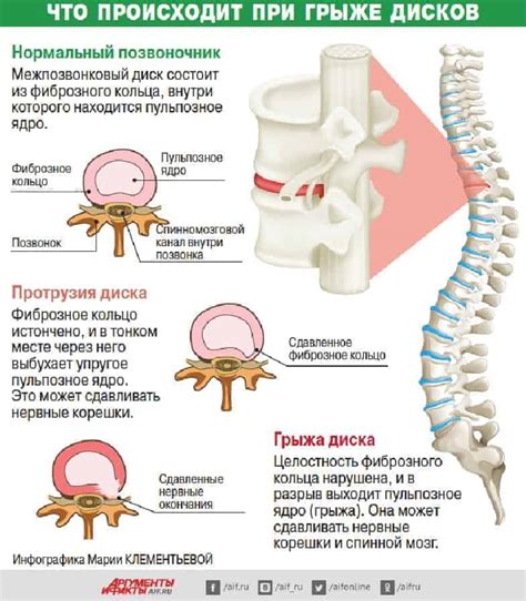 Лечение и профилактика проявлений повреждений межпозвоночных дисков
