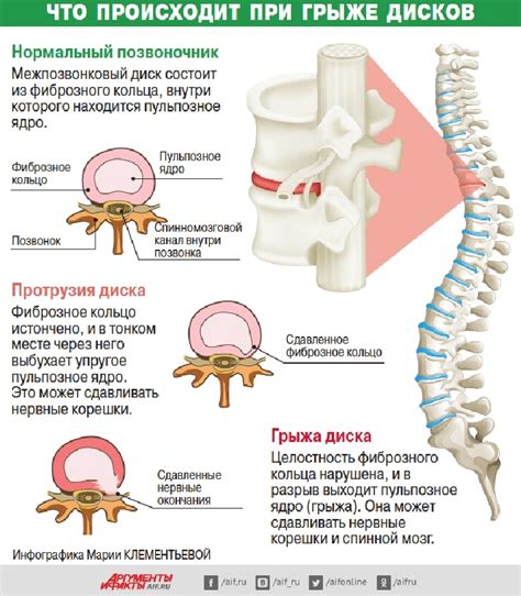 Методы лечения отсутствия диска