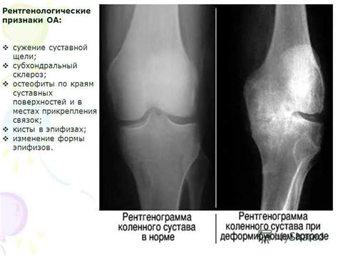 Научное объяснение феномена звука при движении коленных суставов