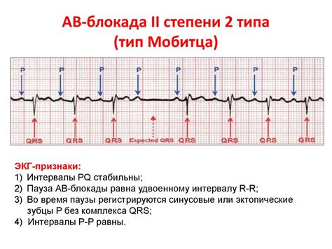 Обнаружение внутрипредсердной блокады 1 степени при ЭКГ и ее интерпретация