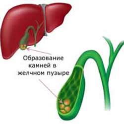 Образование камней в желчном пузыре: процесс и субстанция