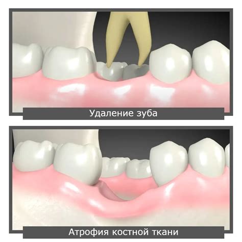 Основные подходы к восстановлению костной ткани при пародонтозе