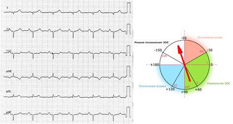 Основные признаки и значение полувертикальной Эос на ЭКГ