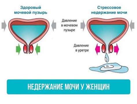 Основные признаки нарушения выведения мочи у женщин