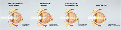 Основные проявления и признаки нарушений зрения