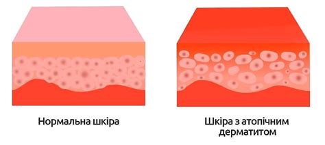 Основные симптомы и признаки нарушения барьерной функции кожи