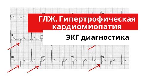 Основные типы изменений структуры левобокого желудочка на записи ЭКГ
