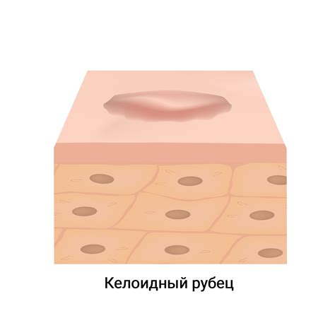 Основные факторы, способствующие образованию келоидных рубцов в результате порезов вен