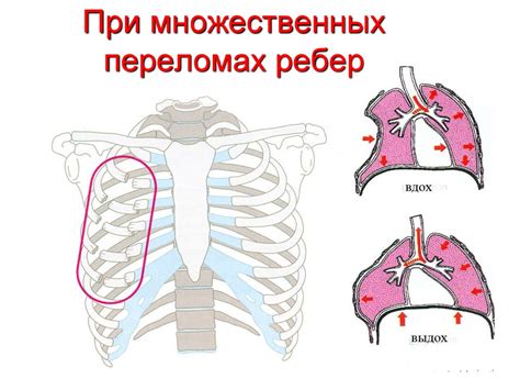 Отек и гематома в зоне перелома ребра