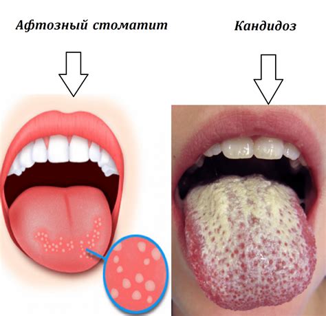 Ощущение жжения и неудобства в полости рта