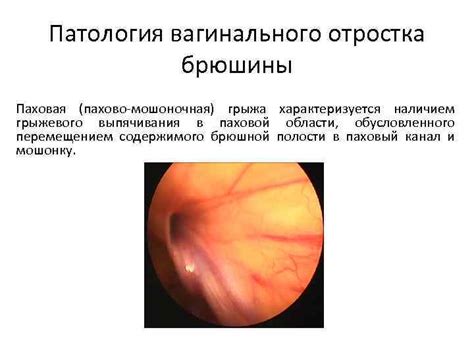 Патология паховой области: разрушение важной структуры тела