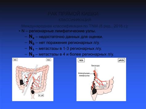 Понимание дисфункции прямой кишки