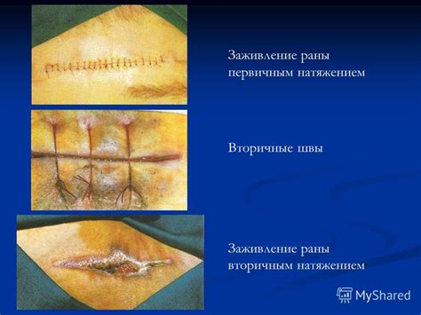 Признаки естественного рассасывания швов в процессе заживления раны