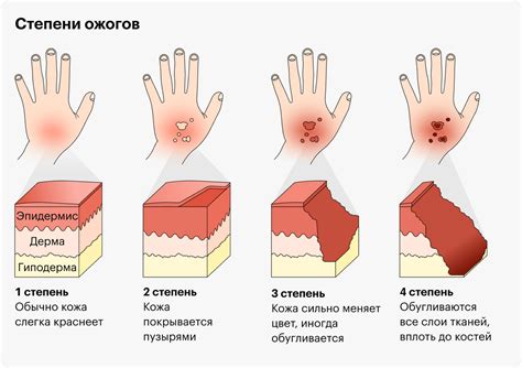 Причины продолжительного болевого синдрома при воспалении кожи после ожога