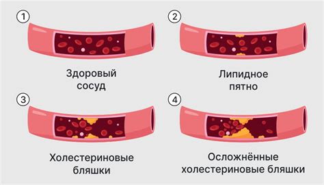 Причины развития атеросклероза