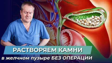 Профилактика образования камней в желчном пузыре: эффективные методы и рекомендации