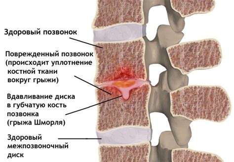 Роль хрящевых узлов шморля в патологии позвоночника