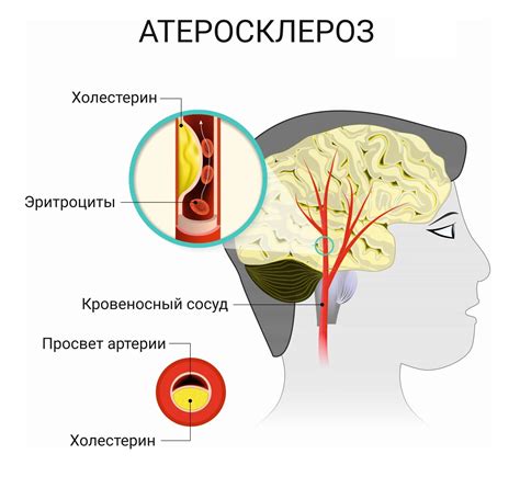 Симптомы и признаки нестенозирующего атеросклероза