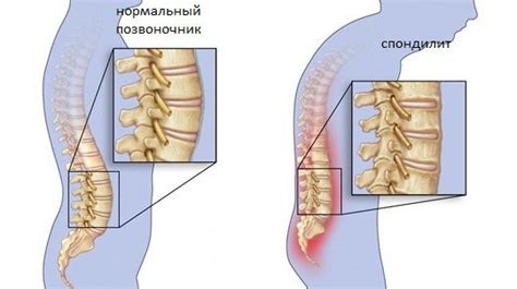 Симптомы неспецифического спондилита позвоночника