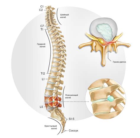 Современные подходы к лечению грыжи в пояснично-крестецовом отделе