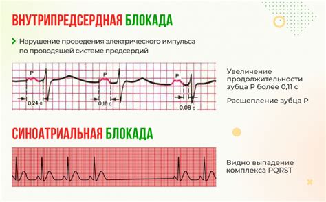 Современные подходы к терапии первой степени внутрипредсердной блокады