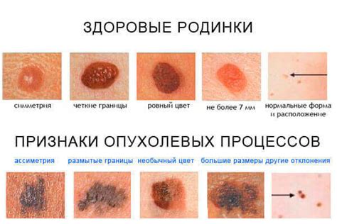 Спонтанная опухоль на коже головы: недостоверное представление о родинке или опухолевом образовании