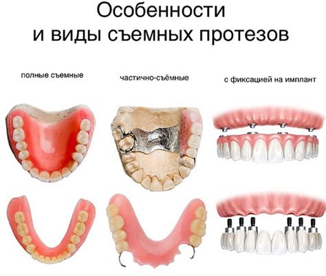 Съемные протезы - альтернатива имплантации