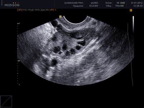 Ультразвуковое исследование яичников: достоверный способ определения резерва яйцеклеток
