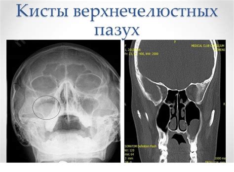 Факторы, влияющие на снижение воздухонасыщенности правой челюстной пазухи