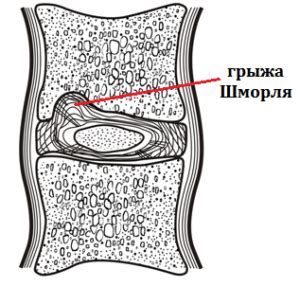 Формирование хрящевых узлов шморля: причины и процесс образования