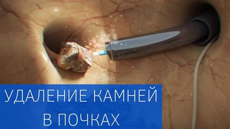 Хирургическое вмешательство для устранения камня в почке: основные методы